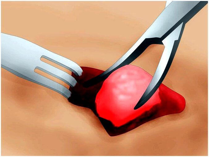 операция по удалению кисты