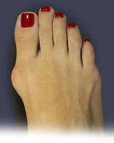 кость на большом пальце