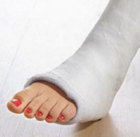 перелом лодыжки