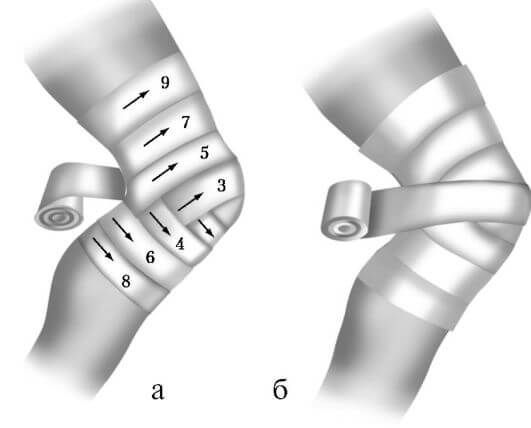 черепашья повязка на коленный сустав