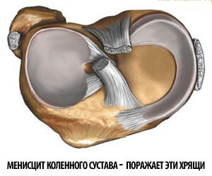 Менисцит коленного сустава