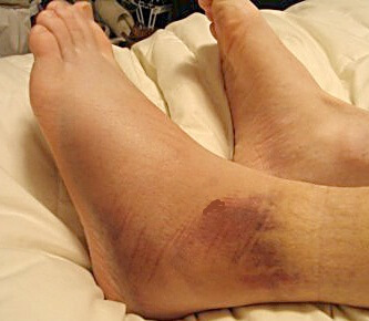 перелом и опухоль