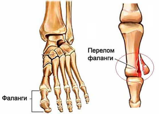 перелом фаланги пальца