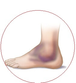 отек при переломе лодыжки