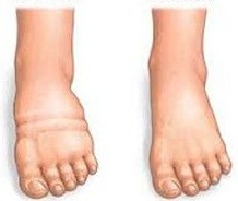 опухоль щиколодки