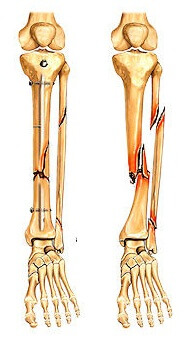 перелом голени