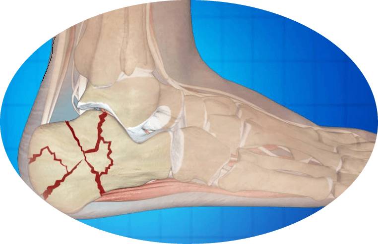 перелом пятки