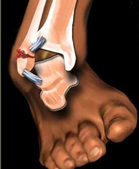 перелом лодыжки