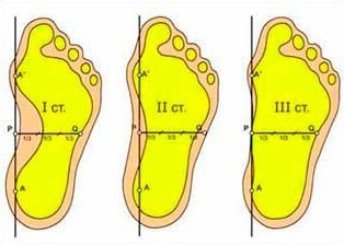 степени деформации стопы