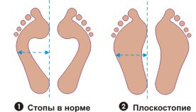 плоскостопие