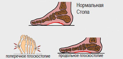 виды плоскостопий