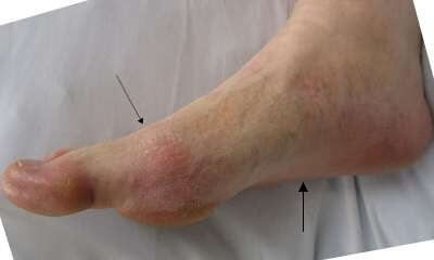 подагра стопы