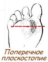 поперечная деформация стоп