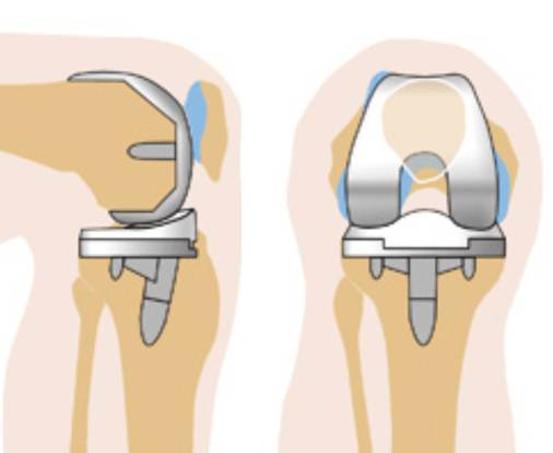 замена сустава