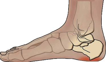 пяточная шпора