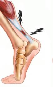 надрыв связок голеностопа
