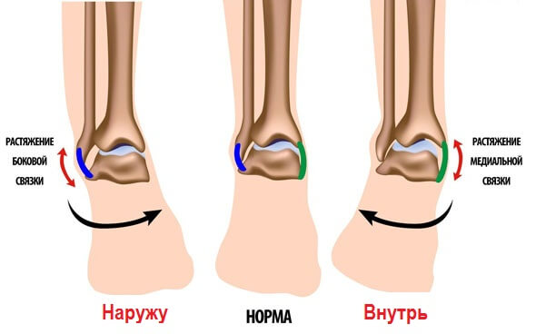 виды растяжений