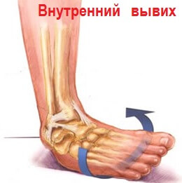 внутренний вывих стопы