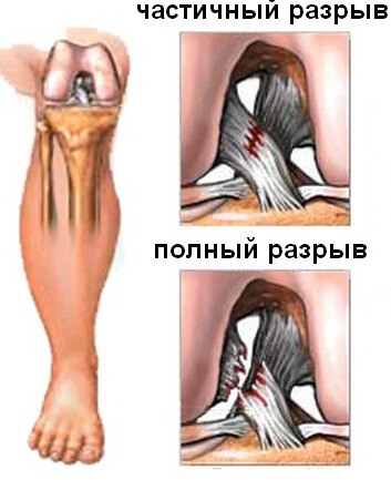 на фото разрывы связок разрыв связок