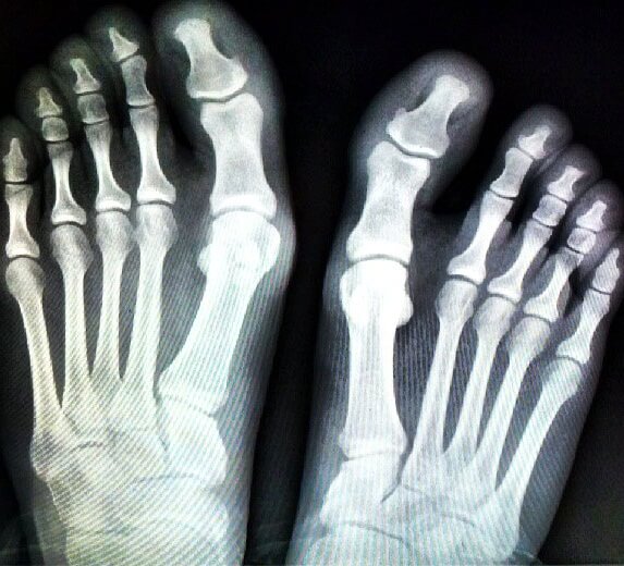 рентген стопы