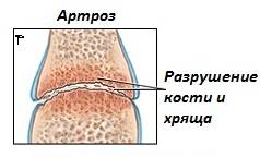 артроз сустава