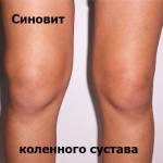 синовит колена