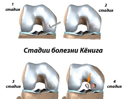 стадии болезни кенига