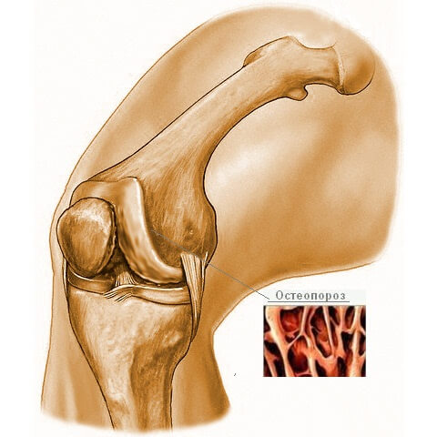 остеопароз коленного сустава
