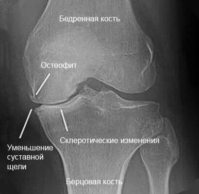 Рентген коленного сустава