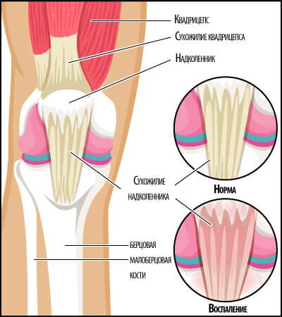 тендит колена