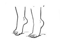 лфк при плоскостопии