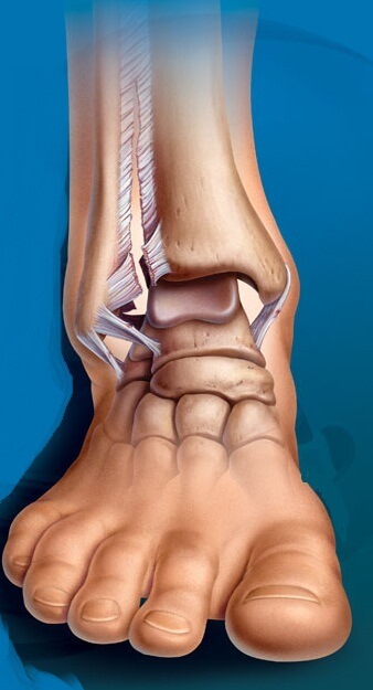 трещина в лодыжке